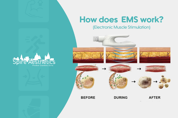 EMS treatment for post pregnancy weight loss treatment Robroyston