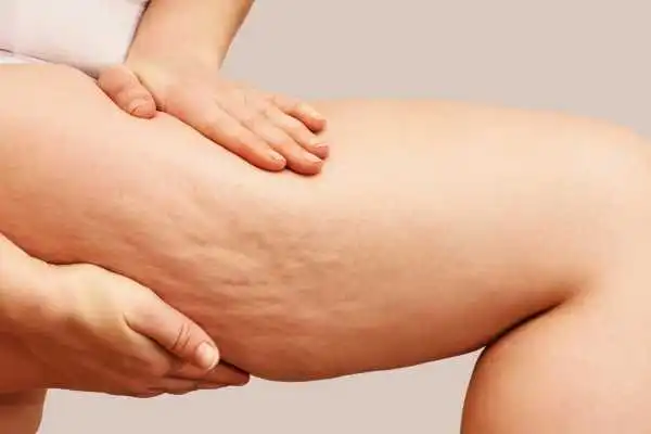 Image of woman showing leg with cellulite Robroyston