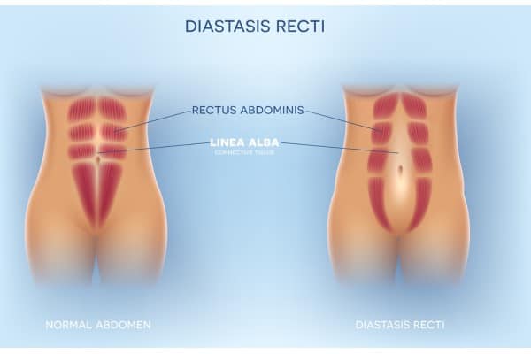What Non-Surgical Options Are Available for Diastasis Recti Robroyston?