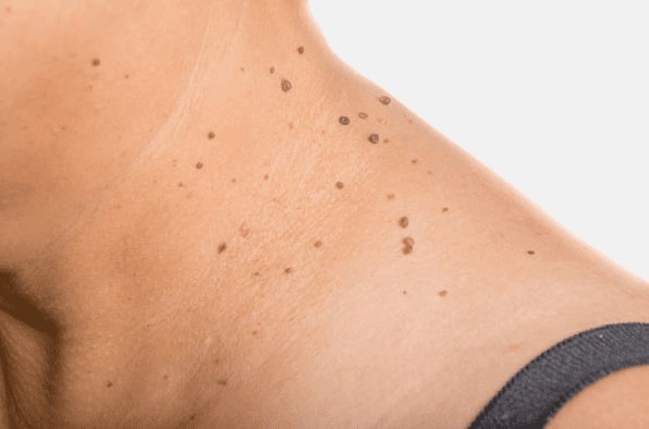 Are you looking for easy skin tag removal Robroyston - then contact Spire today!