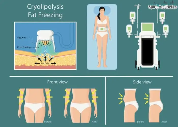 Fat freezing treatment Robroyston benefits for competitions to remove stubborn fat deposits.