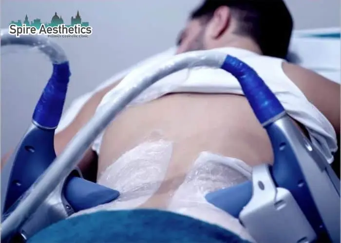 Man having fat freezing treatment done on love handles before a competitions Robroyston to create a sculpted look.