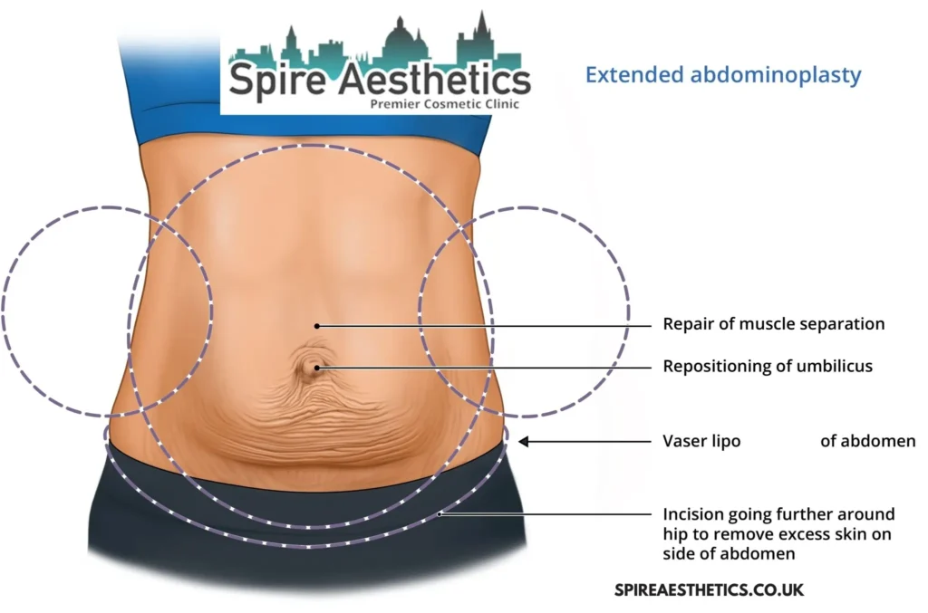 Understanding Loose Skin After Gastric Band Robroyston Surgery and HIFU Treatment
