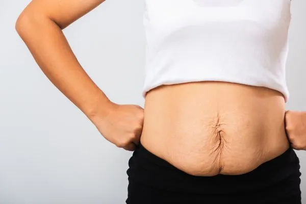 Image of a woman's stomach after weight loss with sagging skin following a gastric band Robroyston