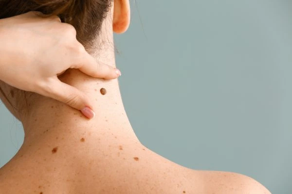 skin blemish removal Robroyston treatment