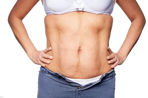 sagging skin on woman's stomach after weight loss injections Robroyston