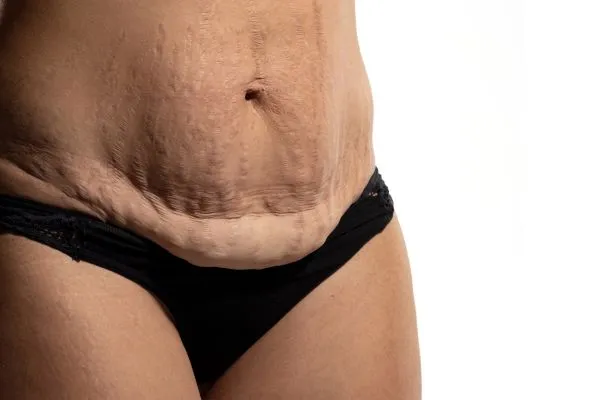 Image of womans stomach after weight loss injections Robroyston showing saggy skin