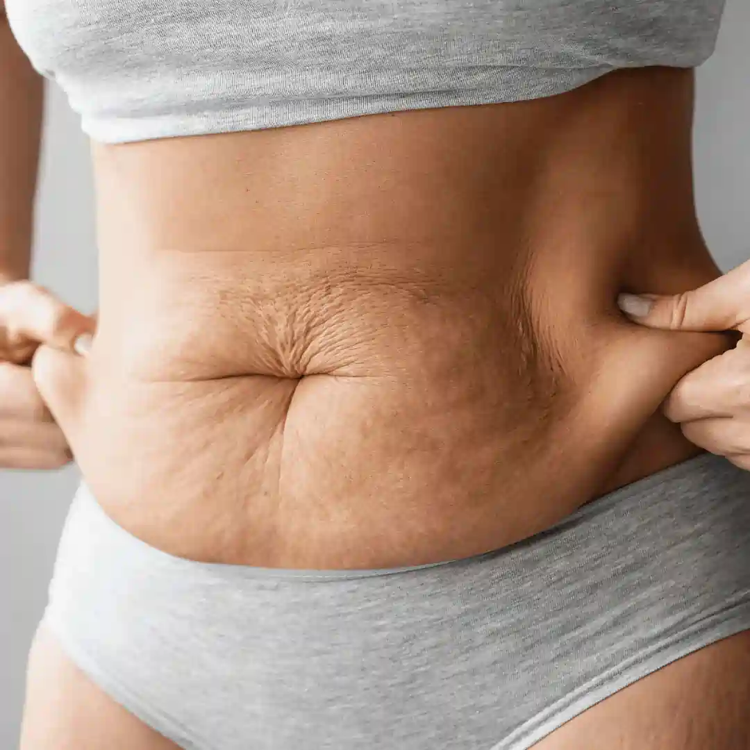 Is It Normal to Have Loose Skin After Pregnancy Robroyston?