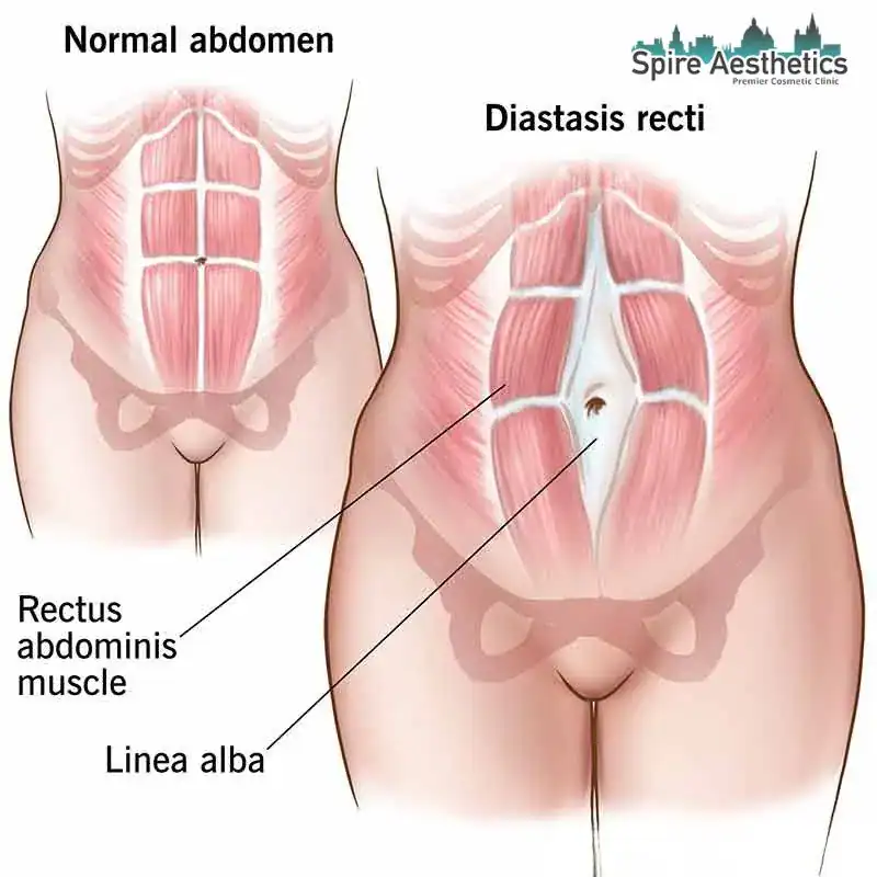 When Will My Belly Feel Normal Again Robroyston?